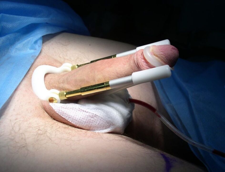 extends after penis enlargement surgery