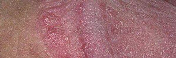 Dry skin and stomach ulcers on the head of the penis after using baking soda