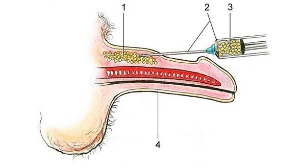 hyaluronic acid injection to make the penis thicker